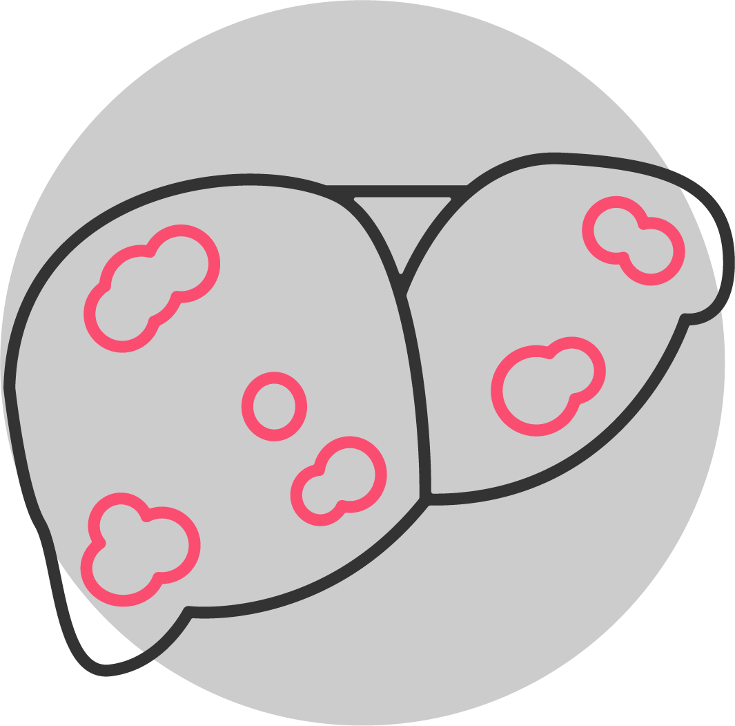 Illustration of a liver with spots indicating Hepatitis A